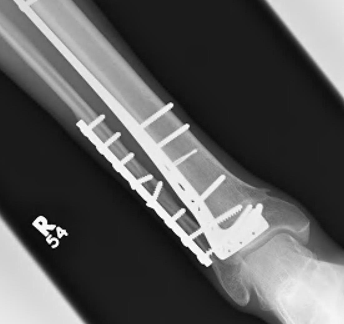 Distal tibial plate 2